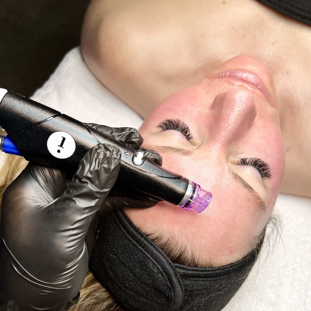 Anderson Aesthetics is the leading provider of Hydrafacial in Alpharetta
