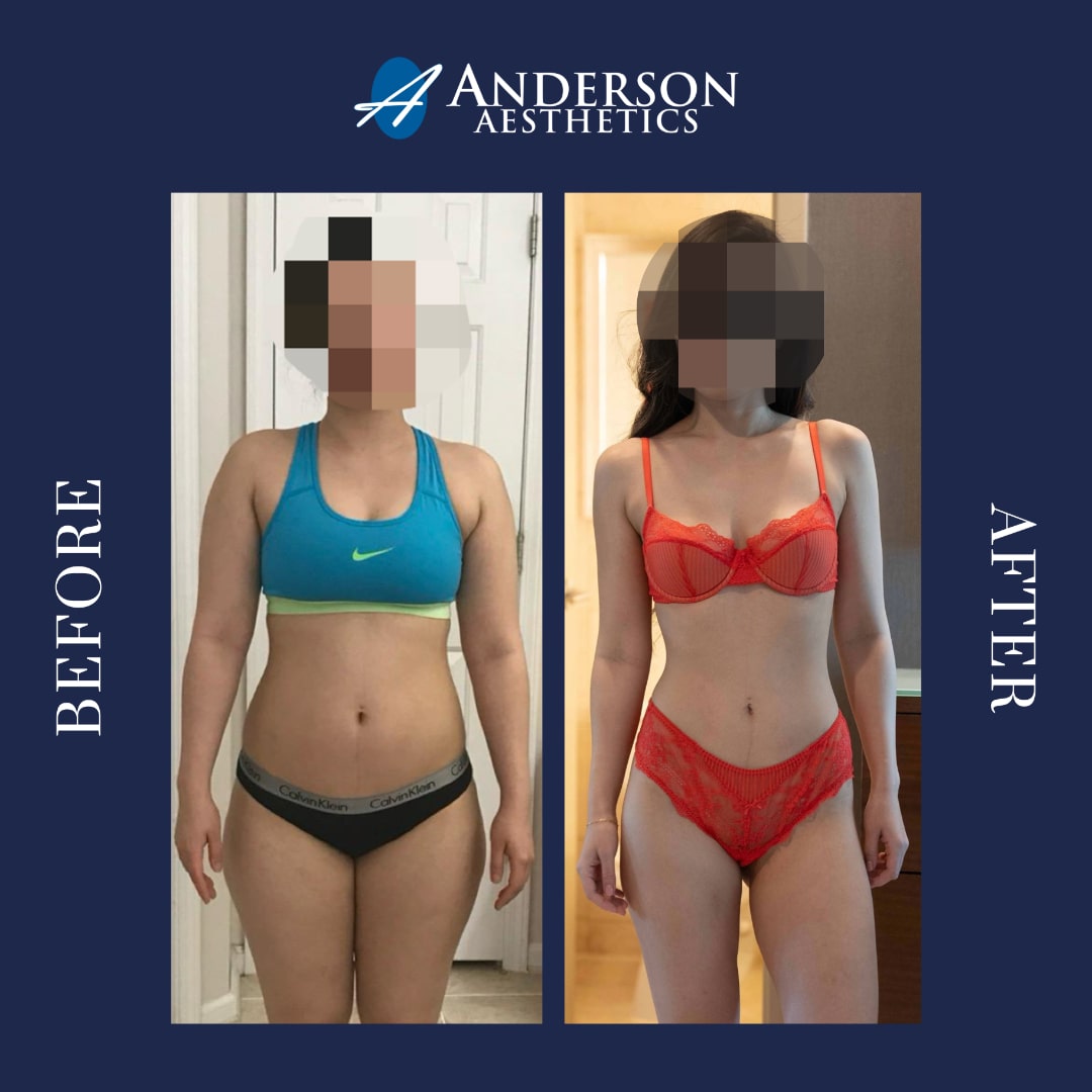Anderson Aesthetics is the leading provide of semaglutide and tirzepatide in Alpharetta and Atlanta