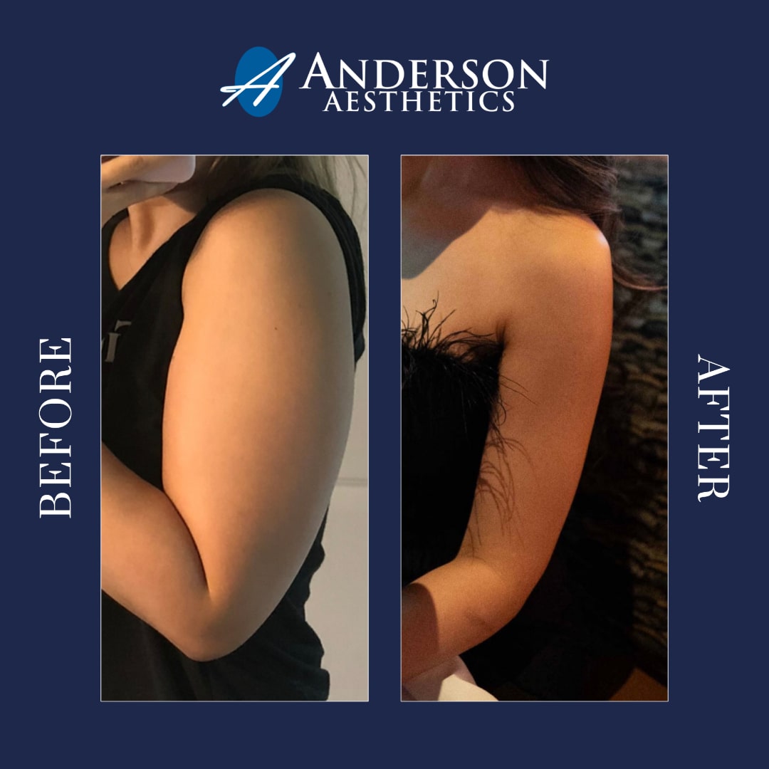 Anderson Aesthetics is the leading provide of semaglutide and tirzepatide in Alpharetta and Atlanta